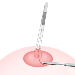 Steps for Lactiferous Duct Incision-cannot breastfeed