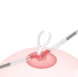 Steps for Lactiferous Duct Incision-cannot breastfeed