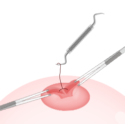 Steps for Lactiferous Duct Incision-cannot breastfeed