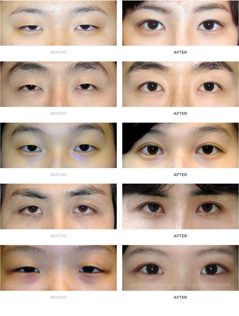 Non-Incision Double Eyelid Surgery Before and After