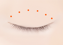 Steps for Non-incision Double Eyelid Surgery Method