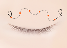 Steps for Non-incision Double Eyelid Surgery Method