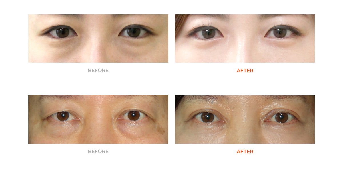 Lower Eyelid Surgery Before and After