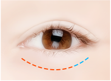 Steps for Lower Eyelid Surgery Method