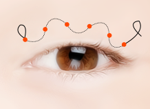Steps for Incision Ptosis Correction Surgery Method