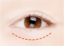 lower blepharoplasty surgery method