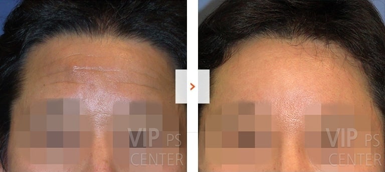 Forehead lift before and after