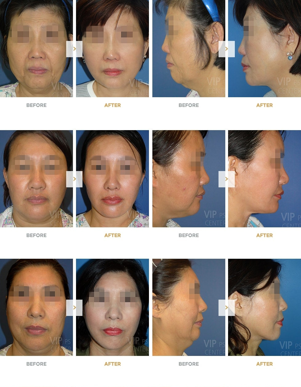 Smas facelift before and after