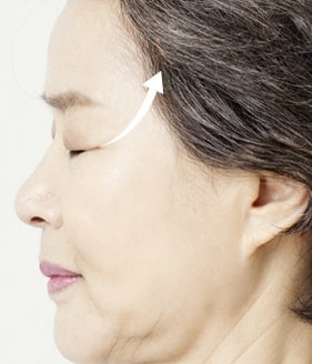 MINIMUM INCISION FACELIFT SURGERY METHOD