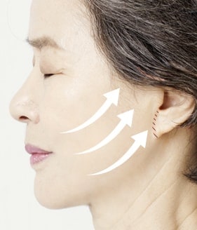 Extended Deep Plane facelift surgery method