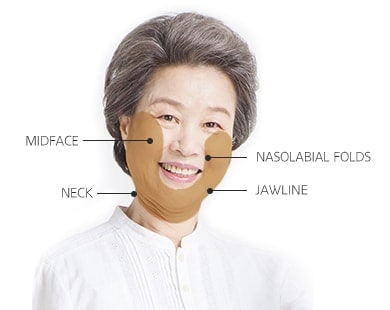 High-SMAS Facelift surgery area