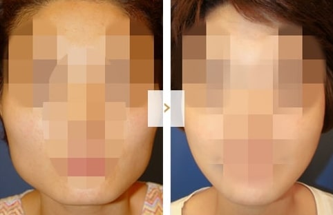 Cheekbone Reduction Surgery - Before and After