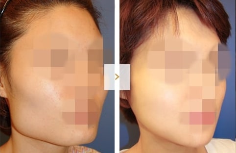 Cheekbone Reduction Surgery - Before and After