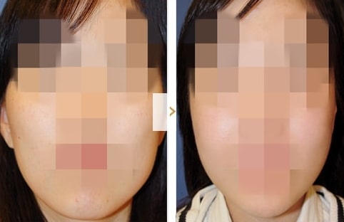 Cheekbone Reduction Surgery - Before and After