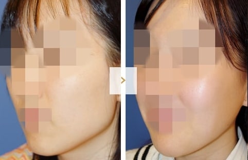 Cheekbone Reduction Surgery - Before and After