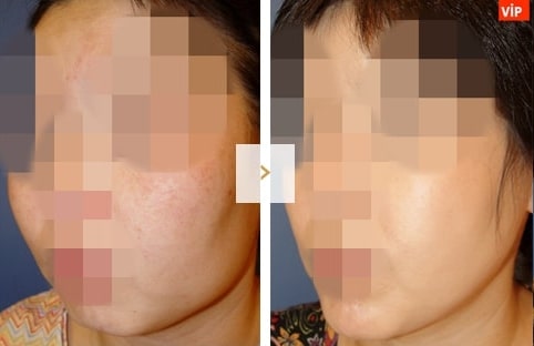 Cheekbone Reduction Surgery - Before and After