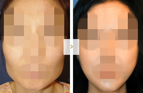 Cheekbone Reduction Surgery - Before and After