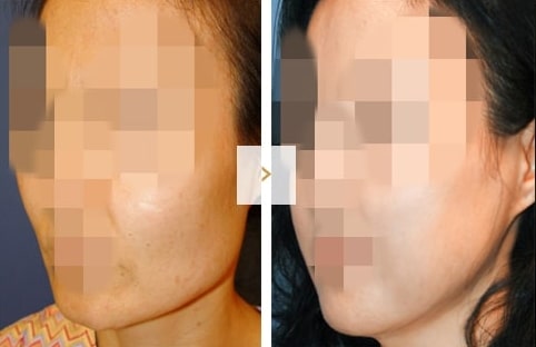 Cheekbone Reduction Surgery - Before and After