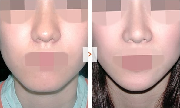 Chin Surgery – Before and After