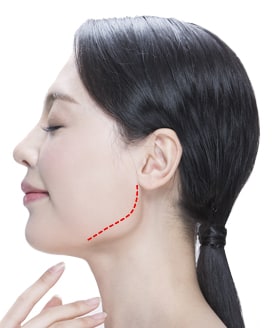 Jaw Reduction Surgery Method – Step 1