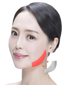 Jaw Reduction Surgery Method – Step 4