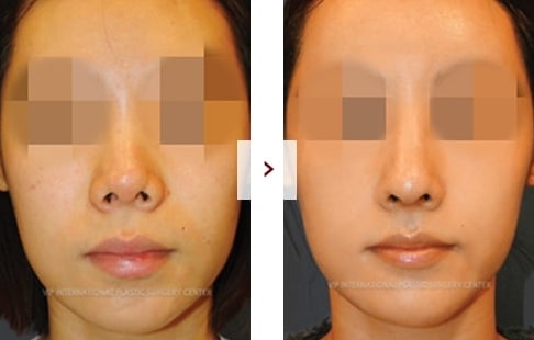 Rhinoplasty Before and After