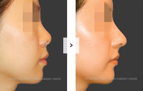 Rhinoplasty Before and After