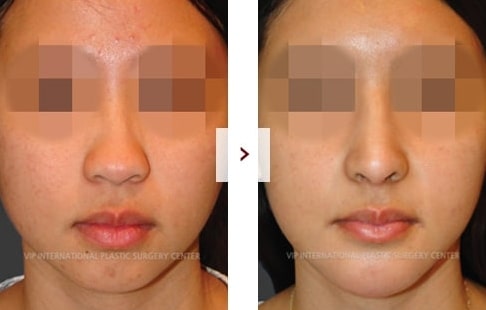 Rhinoplasty Before and After