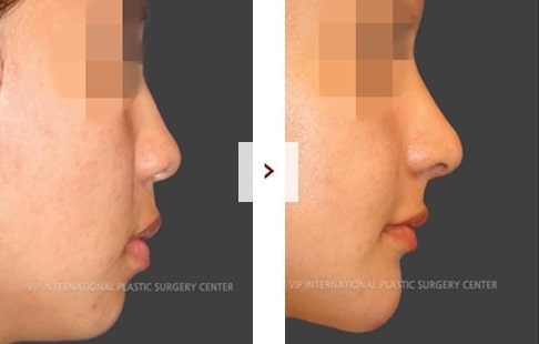 Rhinoplasty Before and After