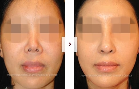 Rhinoplasty Before and After