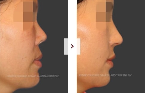 Rhinoplasty Before and After