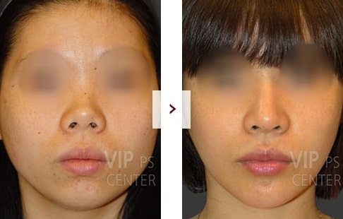 Rhinoplasty Before and After