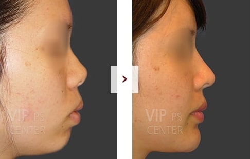 Rhinoplasty Before and After