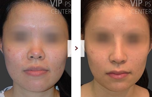 Rhinoplasty Before and After