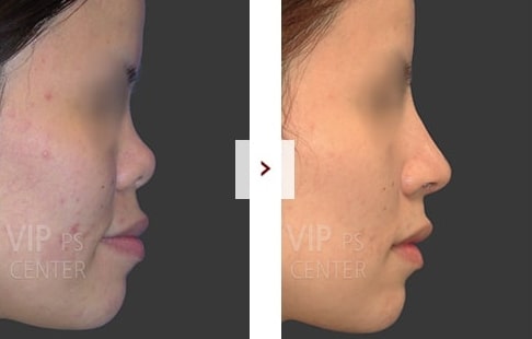 Rhinoplasty Before and After