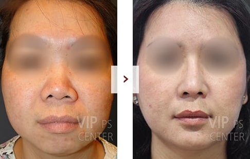 Rhinoplasty Before and After