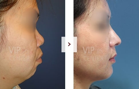 Rhinoplasty Before and After