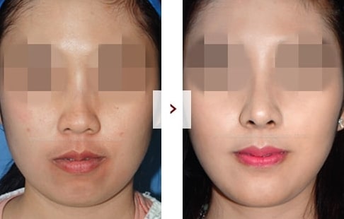 Rhinoplasty Before and After