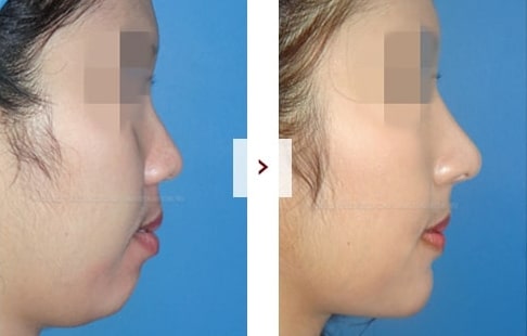 Rhinoplasty Before and After