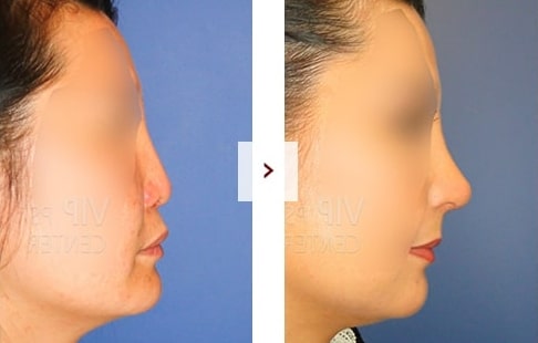 Rhinoplasty Before and After