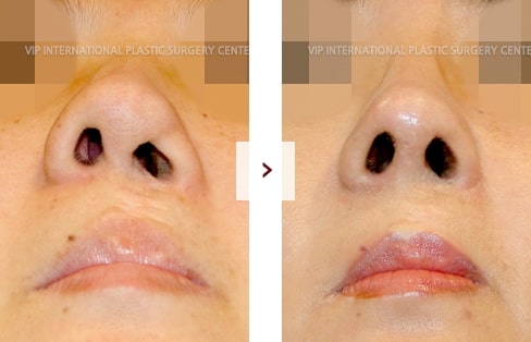 Cleft Lip Rhinoplasty Surgery Before and After