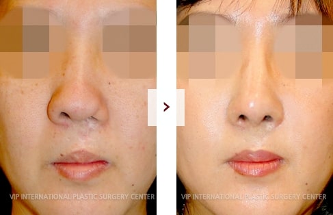 Cleft Lip Rhinoplasty Surgery Before and After