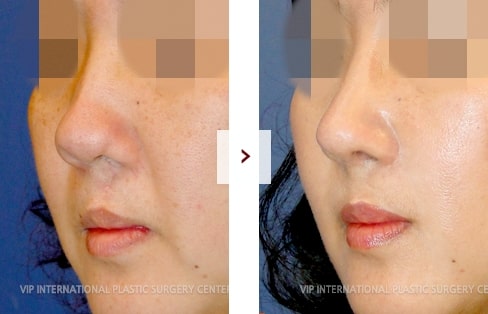 Cleft Lip Rhinoplasty Surgery Before and After