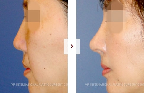 Cleft Lip Rhinoplasty Surgery Before and After