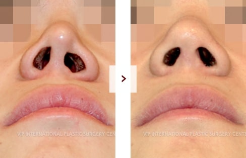 Cleft Lip Rhinoplasty Surgery Before and After