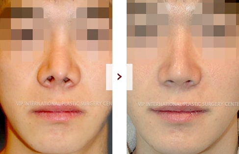 Cleft Lip Rhinoplasty Surgery Before and After