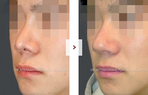 Cleft Lip Rhinoplasty Surgery Before and After