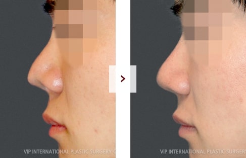 Cleft Lip Rhinoplasty Surgery Before and After