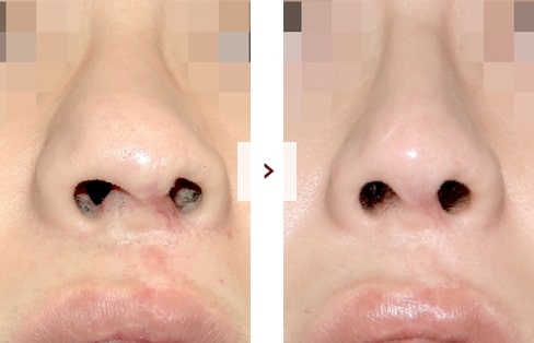 Cleft Lip Rhinoplasty Surgery Before and After