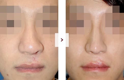 Cleft Lip Rhinoplasty Surgery Before and After